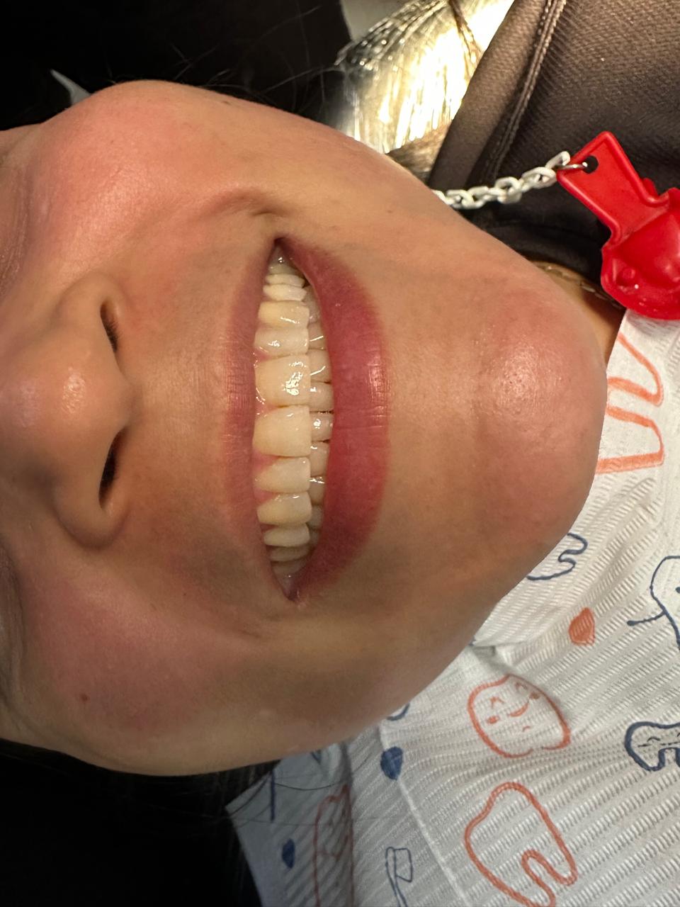 Blanqueamiento Dental - Antes