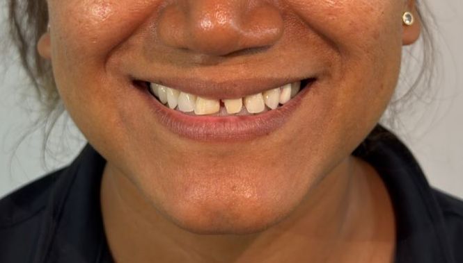 Carillas de composite premium - Antes