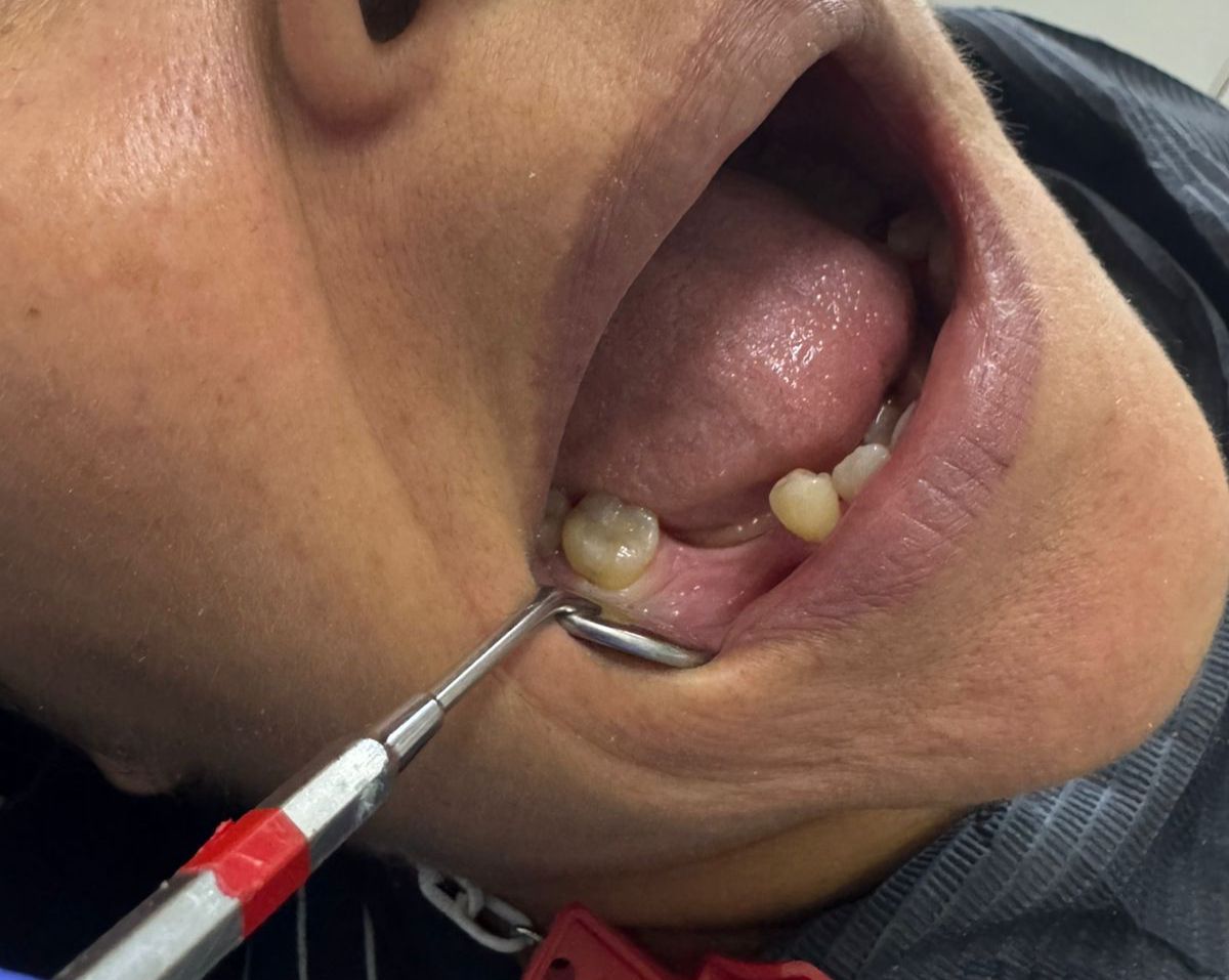 Rehabilitación oral - Antes