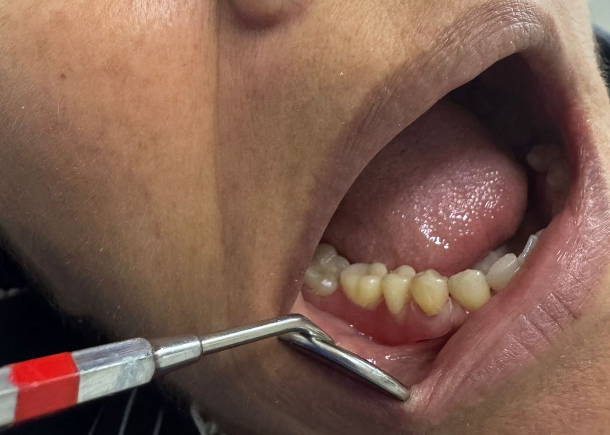 Rehabilitación oral - Después